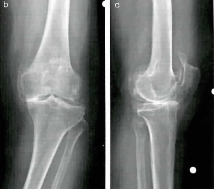 膝における病気～変形性膝関節症とは？？～